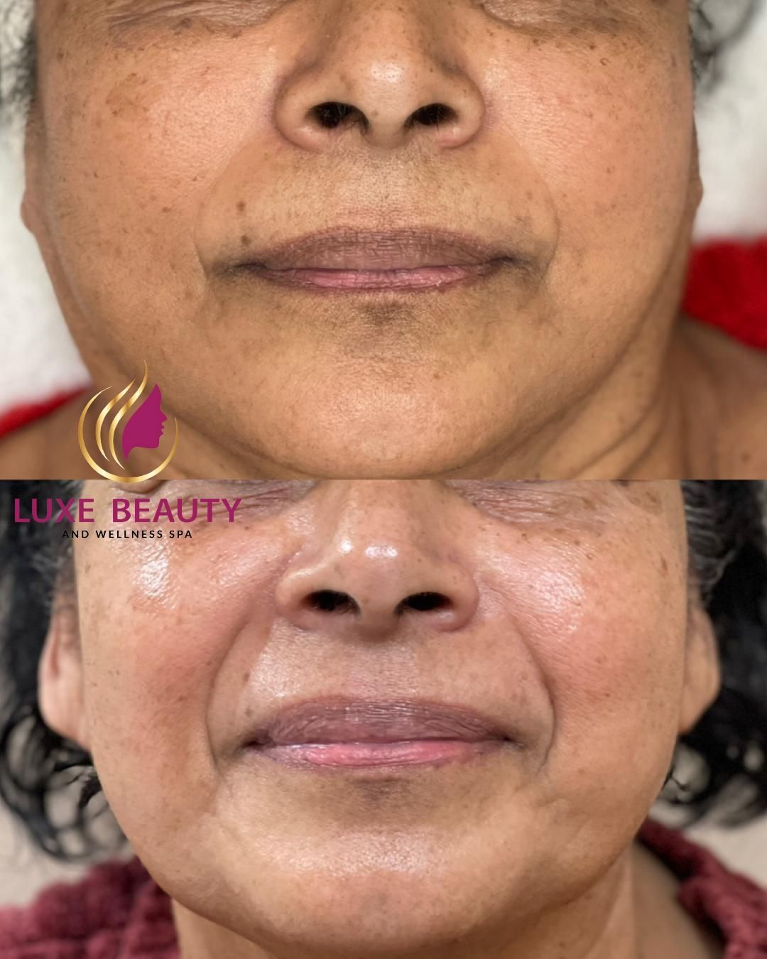 Lower face wrinkles around mouth showing fine lines and skin aging