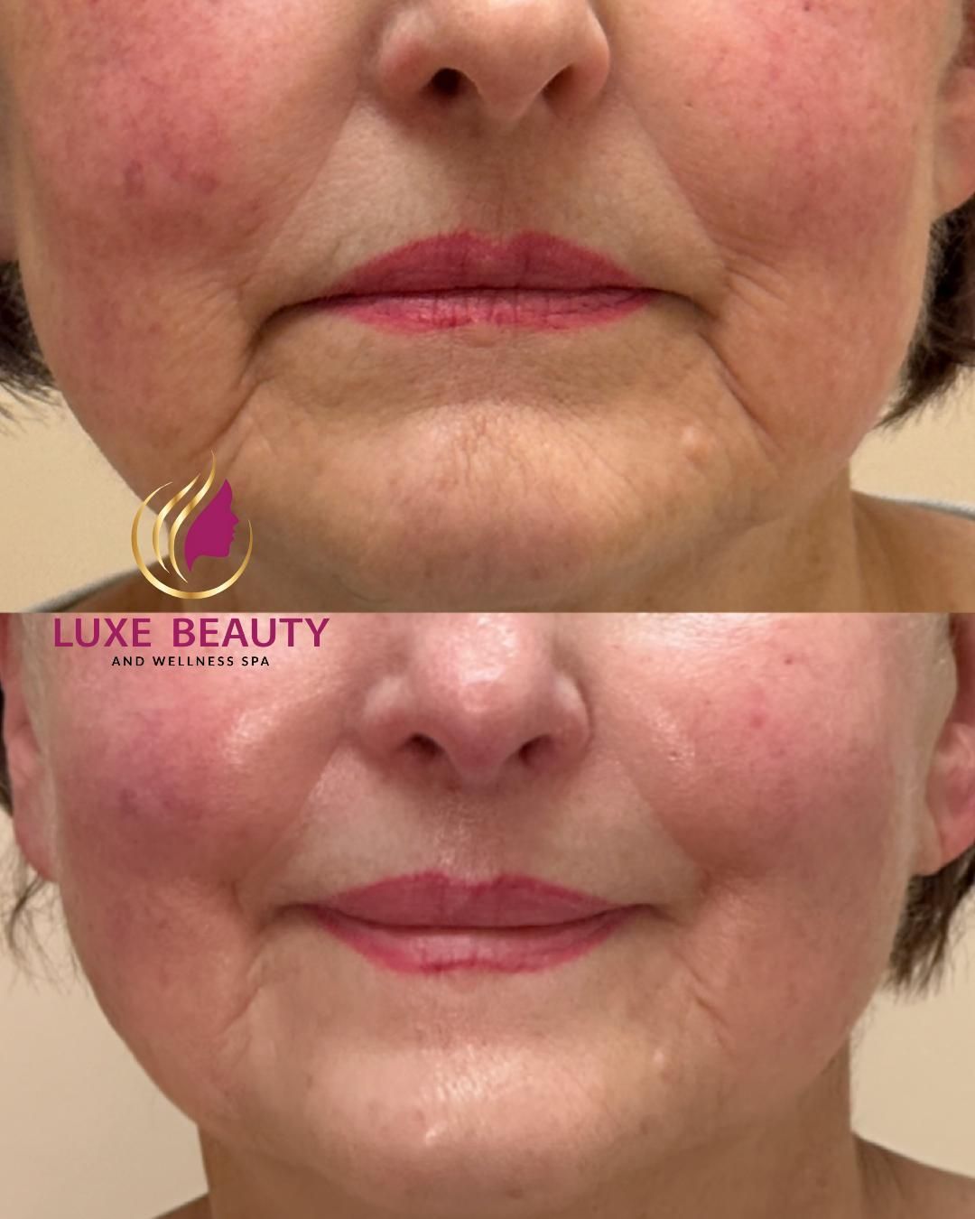 Lower face wrinkles and skin laxity around mouth area
