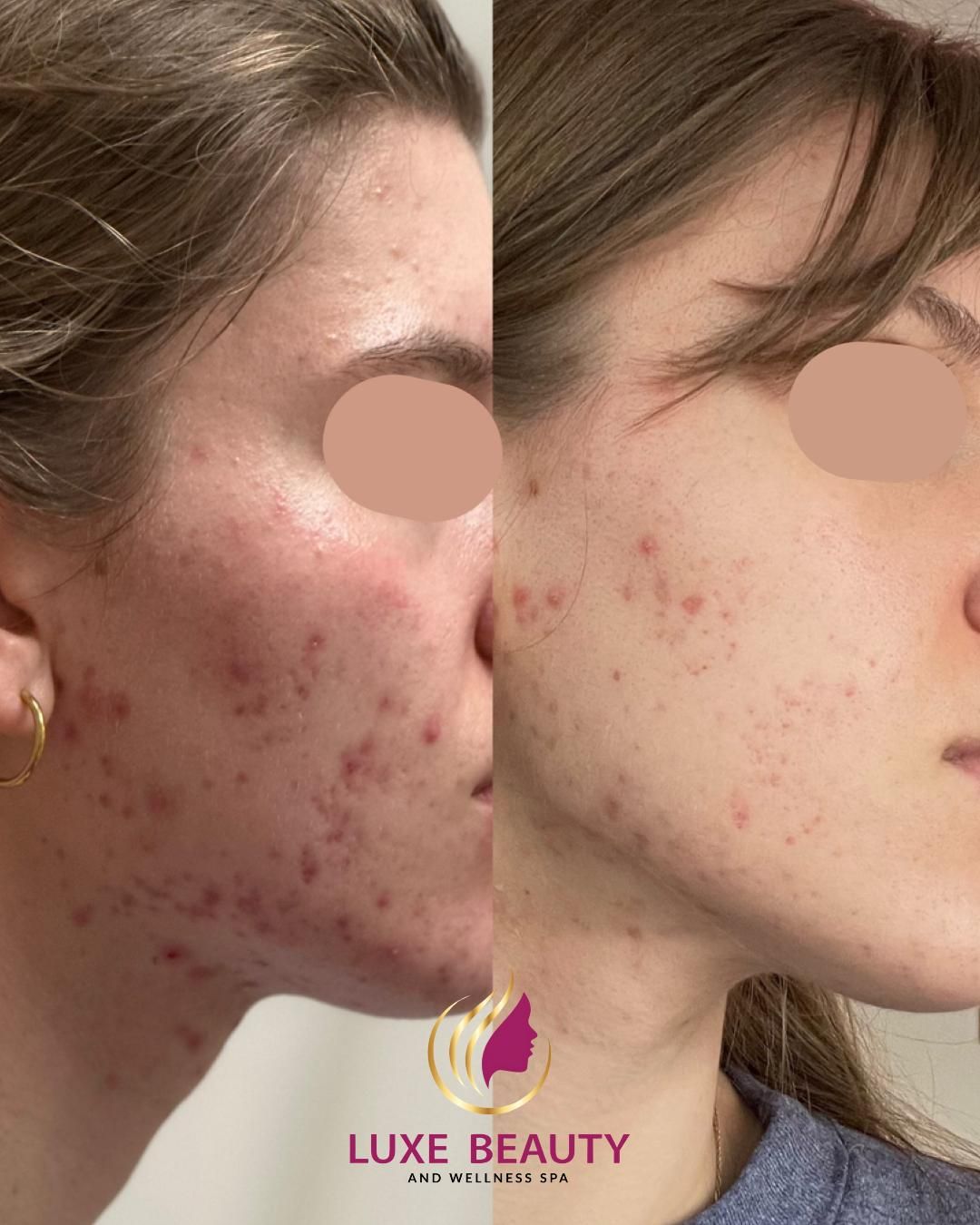 Forehead fine lines and wrinkles shown before and after skin treatment