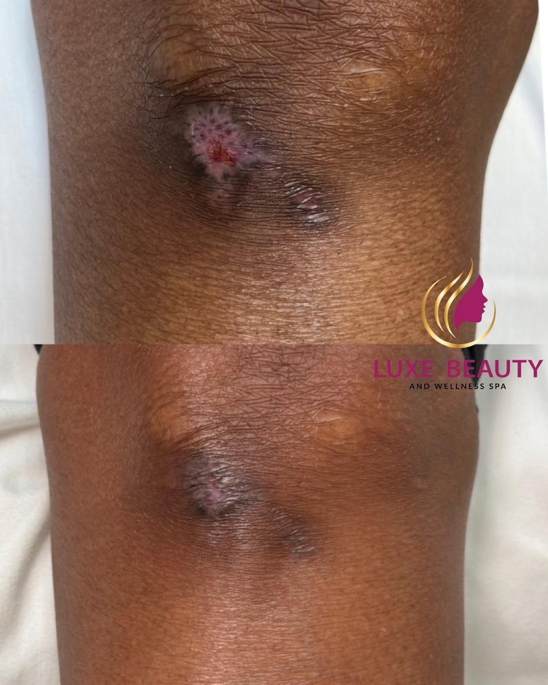 Before and after raised scar on knee showing reduced inflammation and smoother skin texture