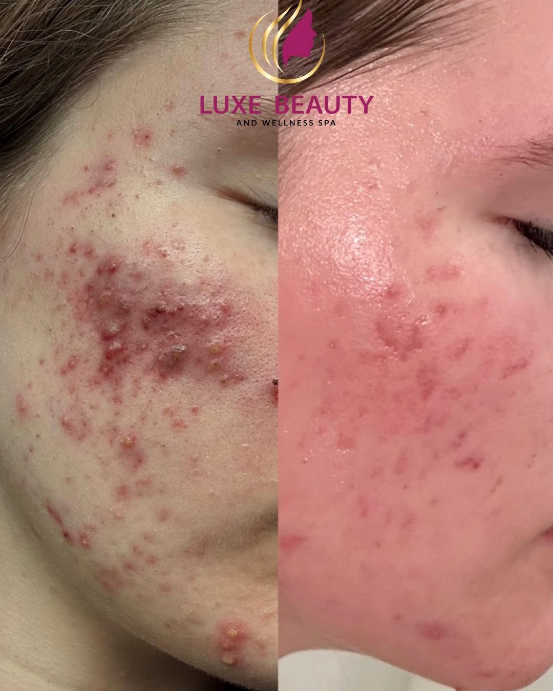 Cheek acne and post-acne marks showing inflamed skin and pigmentation