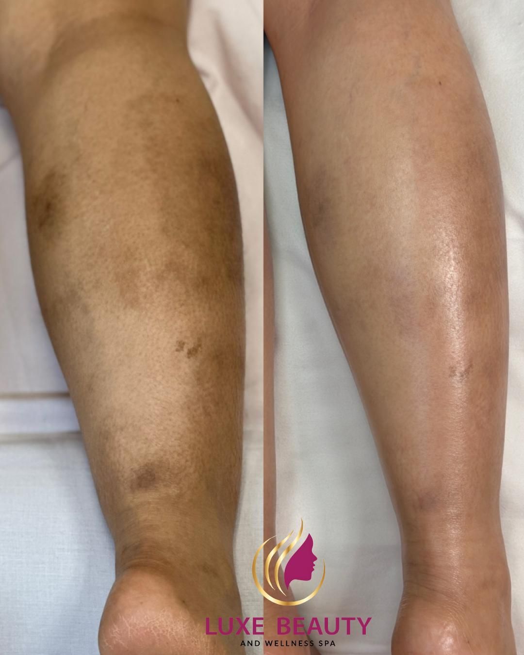 Legs showing uneven skin tone and texture comparison before and after treatment