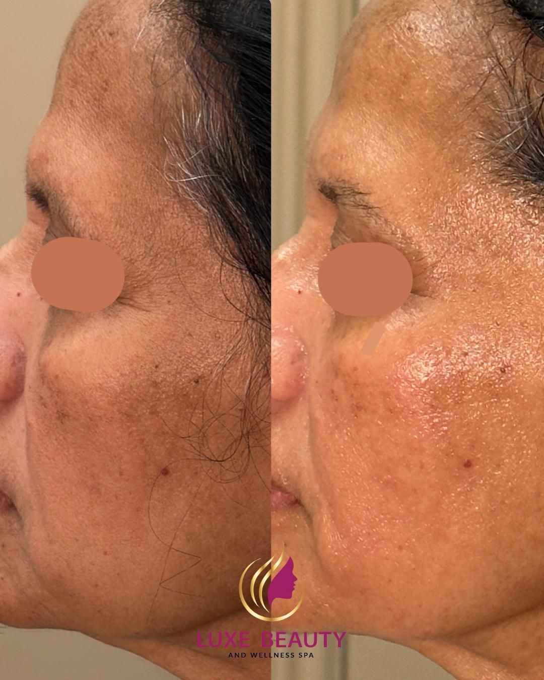 Small facial scar on cheek showing skin texture and mark before treatment