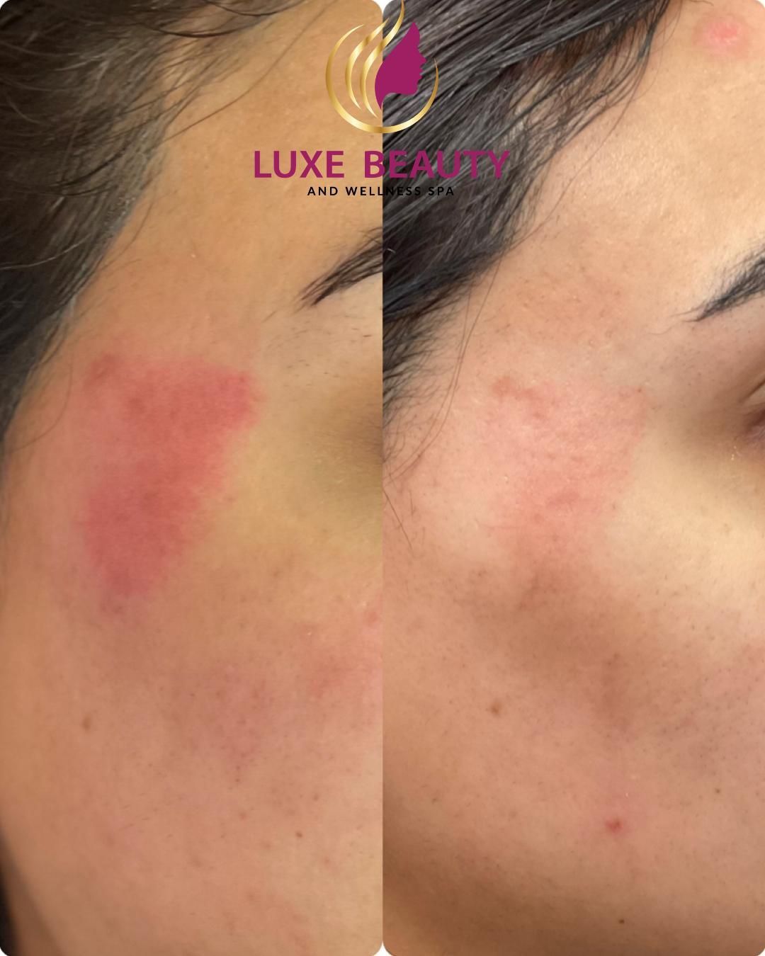 Localized skin redness and irritation on cheek area before treatment