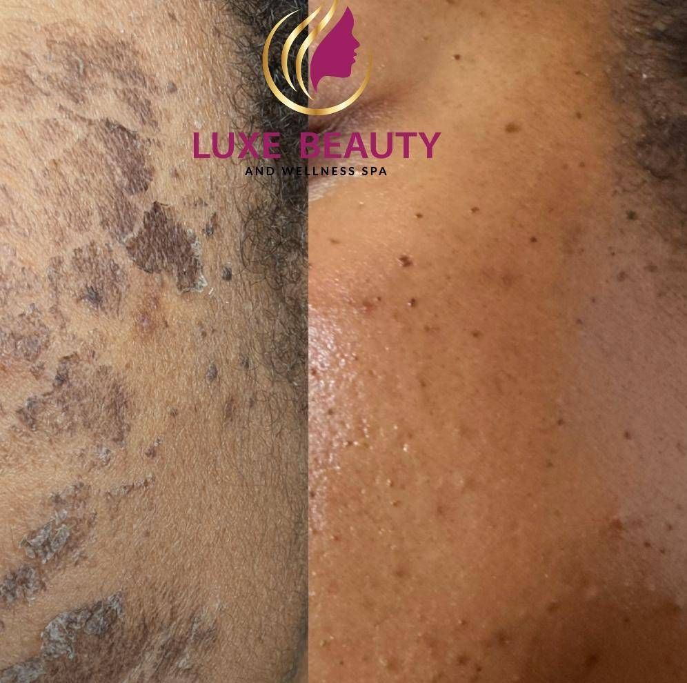 Severe hyperpigmentation and melasma before treatment at Luxe Beauty Mississauga