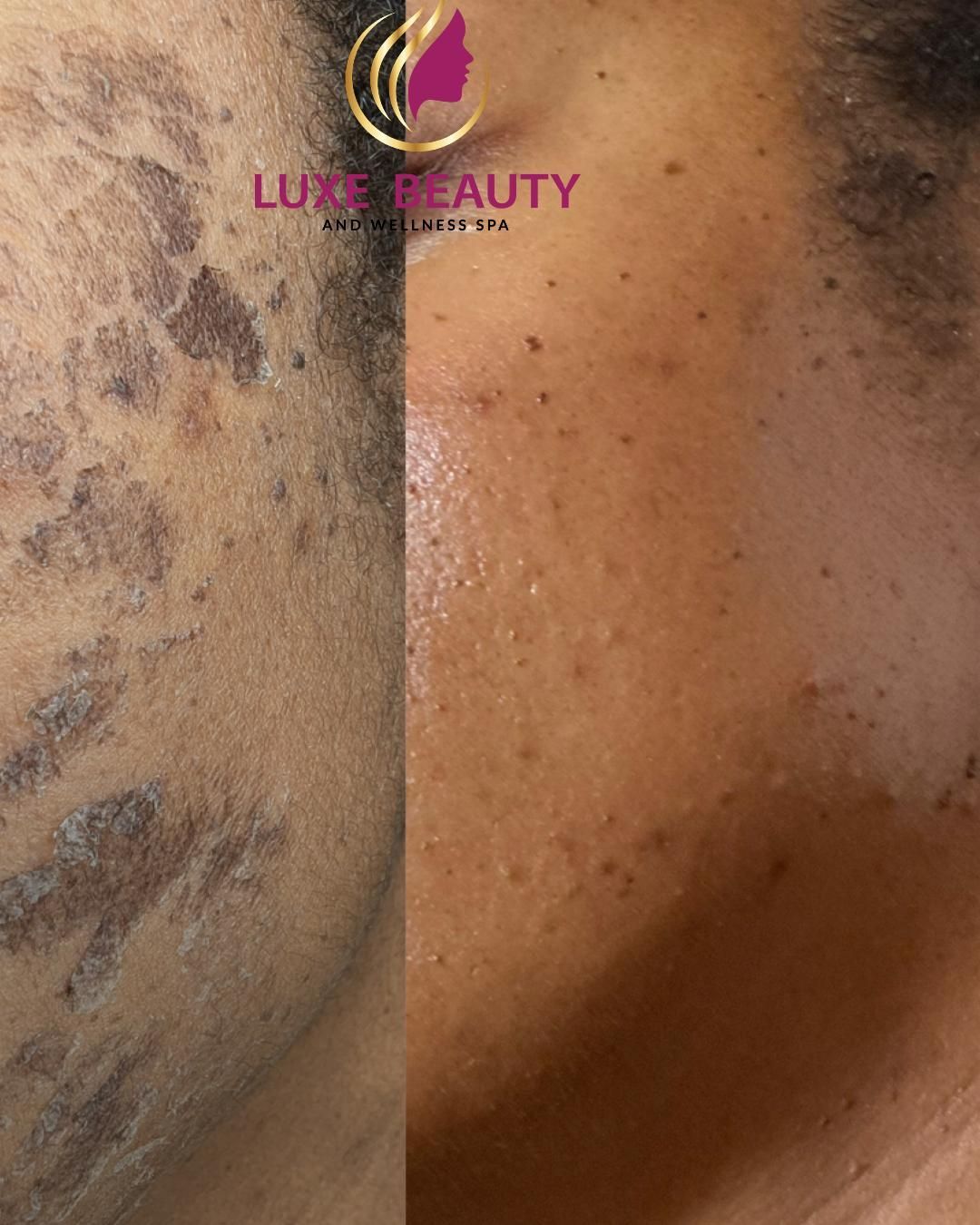 Before and after hyperpigmentation on skin showing reduced dark spots and improved tone
