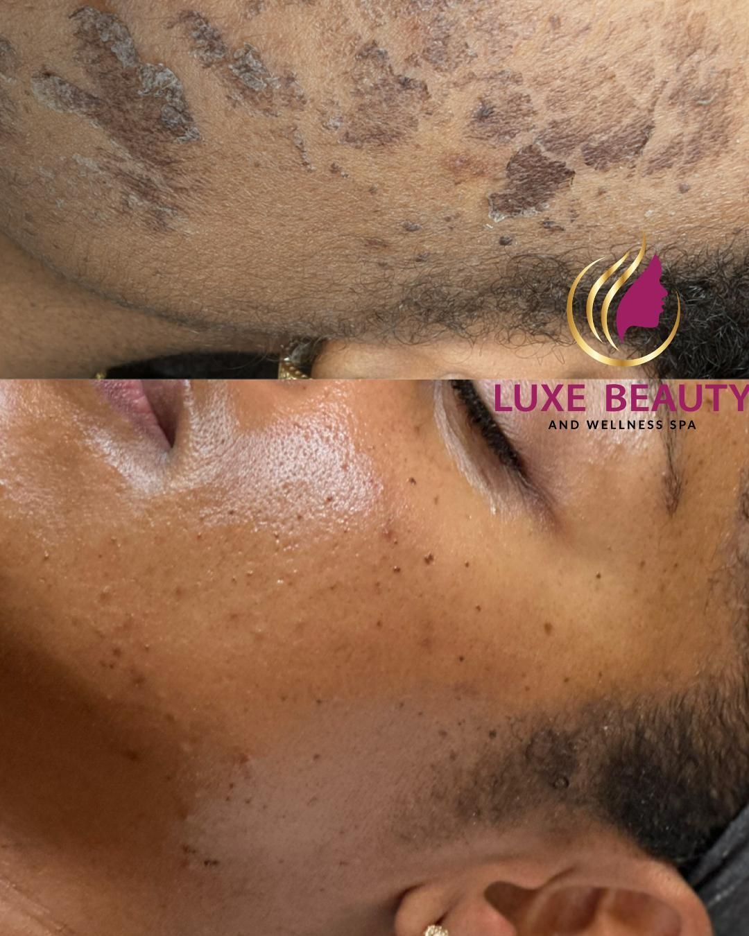 Neck hyperpigmentation with dark patches and uneven skin tone before treatment