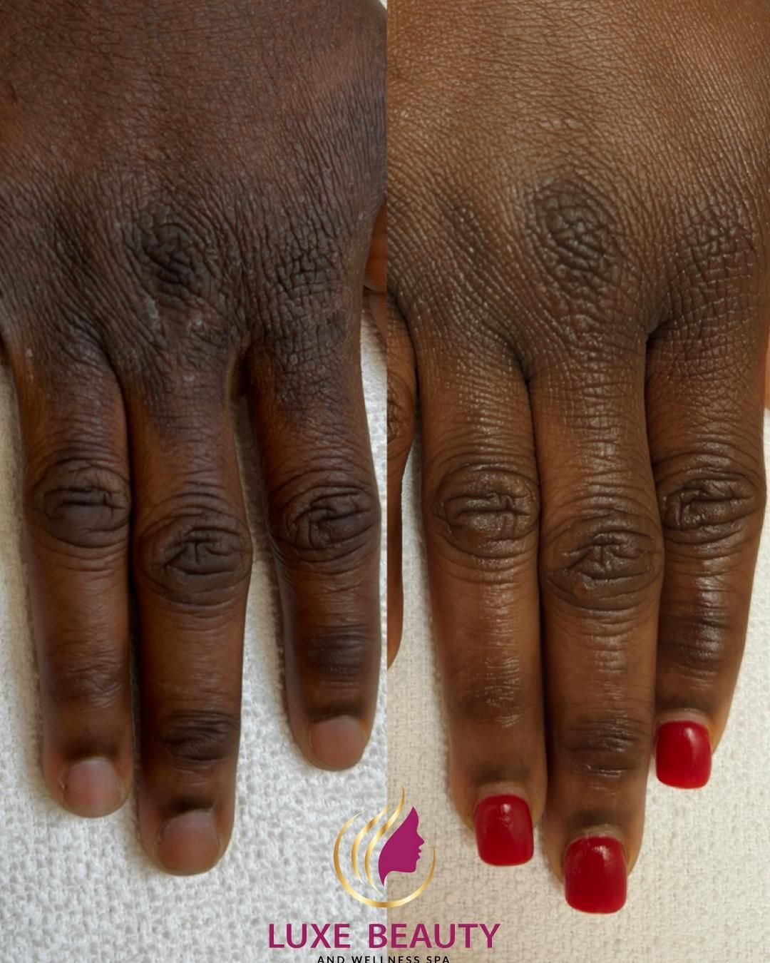 Dark pigmentation on hands showing uneven skin tone and discoloration