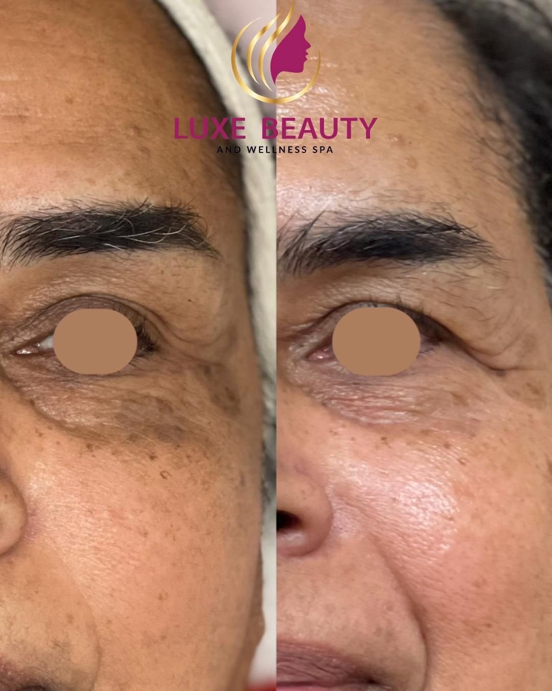 Forehead before and after showing reduced fine lines and improved skin texture
