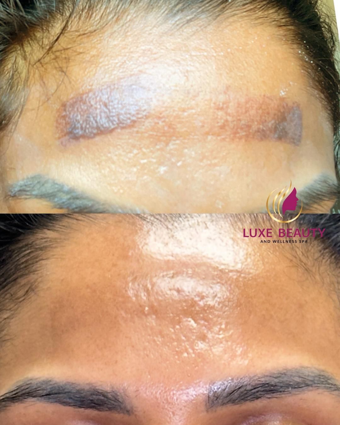 Before and after forehead hyperpigmentation showing reduced dark patches and improved skin tone after treatment