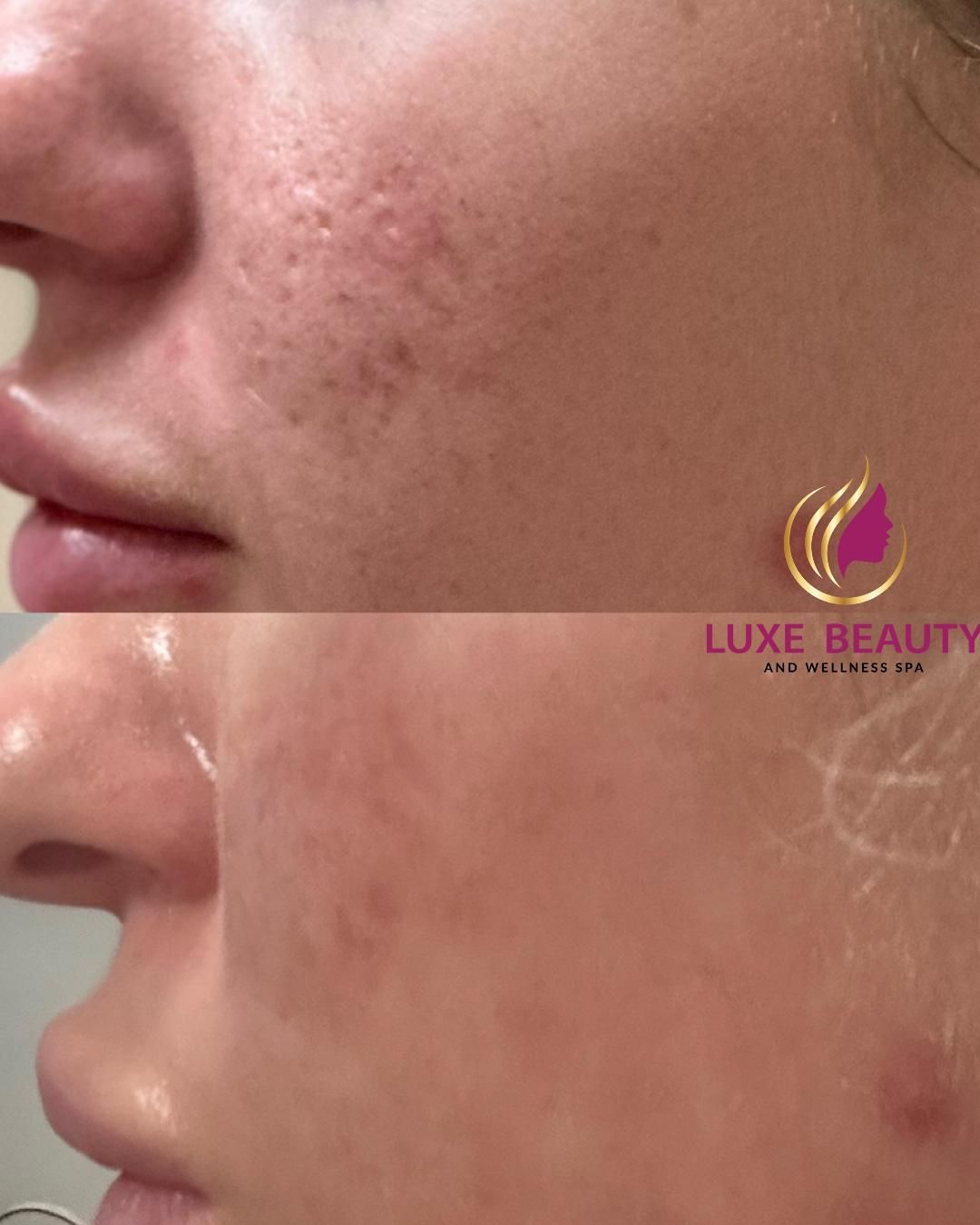 Cheek acne and redness showing inflamed skin and breakouts before treatment