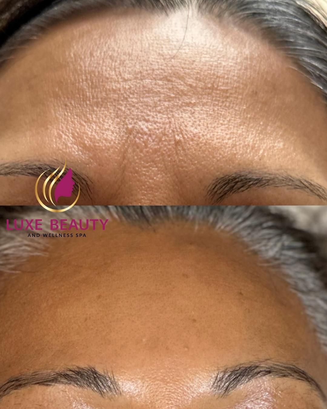 Forehead skin texture showing fine lines and uneven tone before treatment