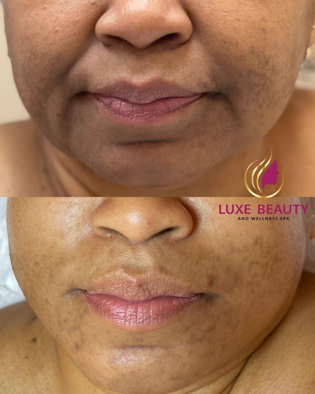 Lower face showing mild skin laxity and uneven texture around mouth area