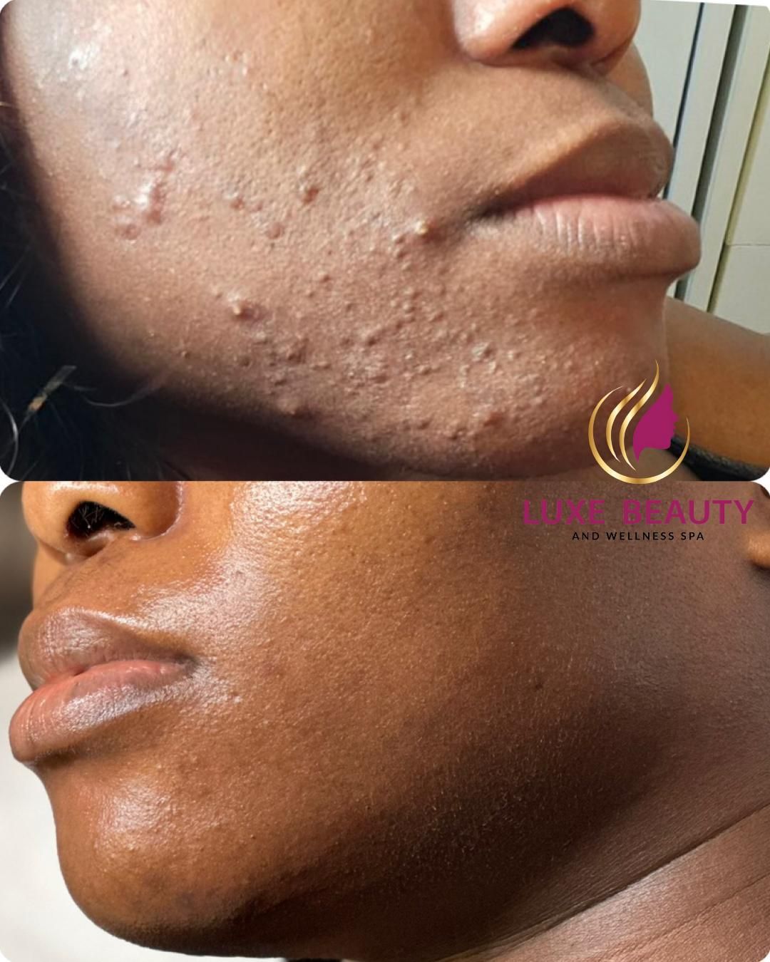 Jawline acne and acne scars showing uneven skin texture
