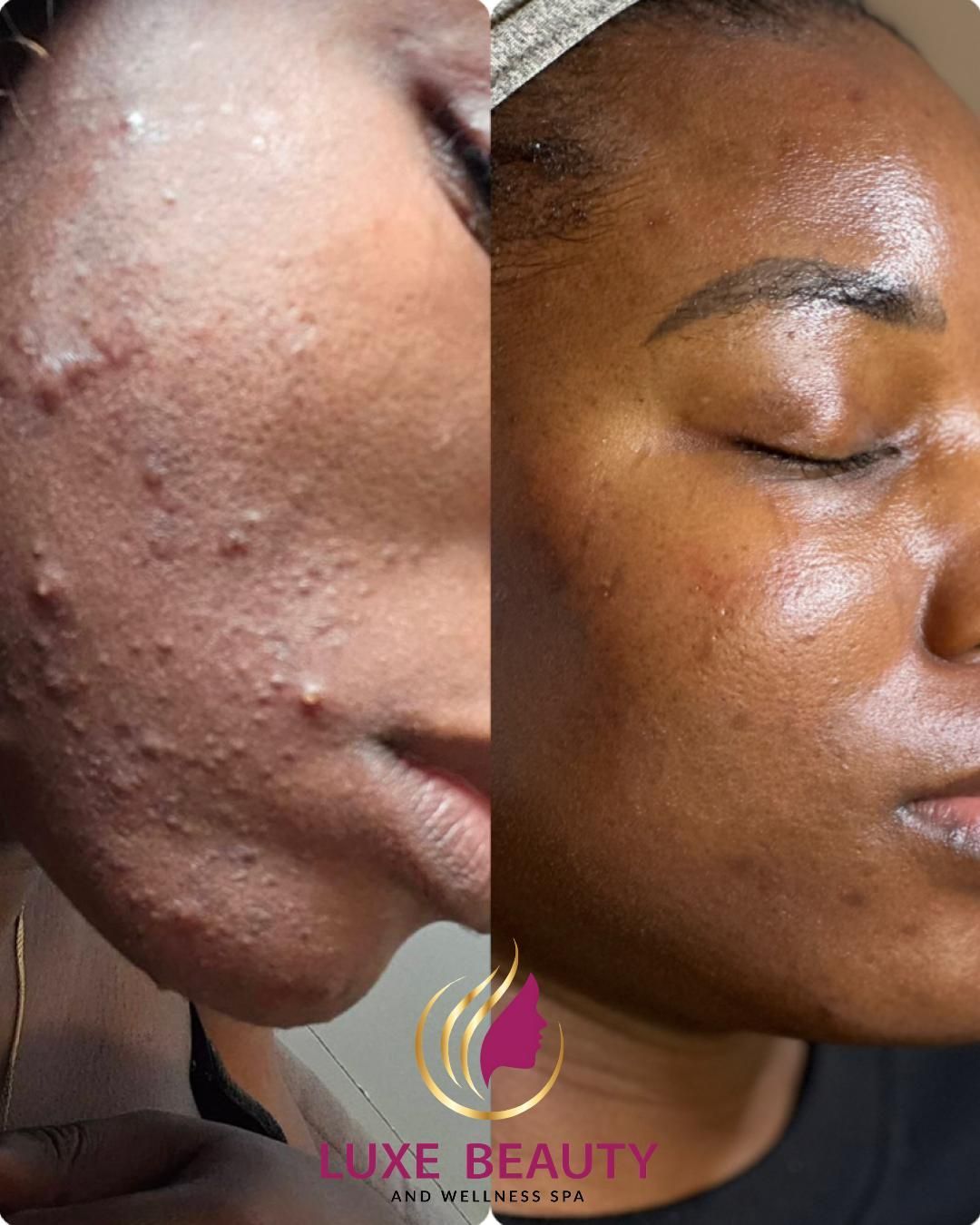 Under eye area showing dark circles and uneven skin tone