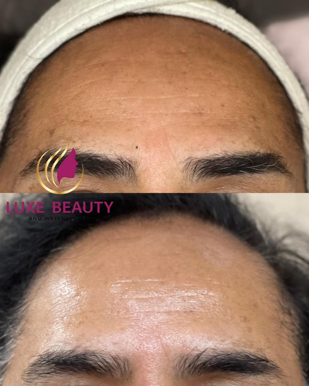 Forehead skin showing smooth texture and even tone