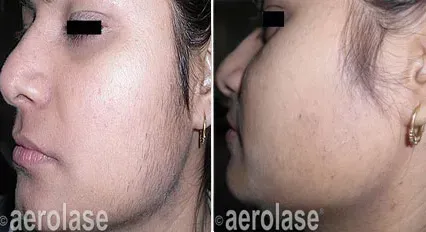 Facial hair removal Aerolase results
