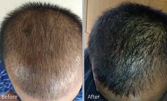 calp hair restoration results showing improved density after treatment