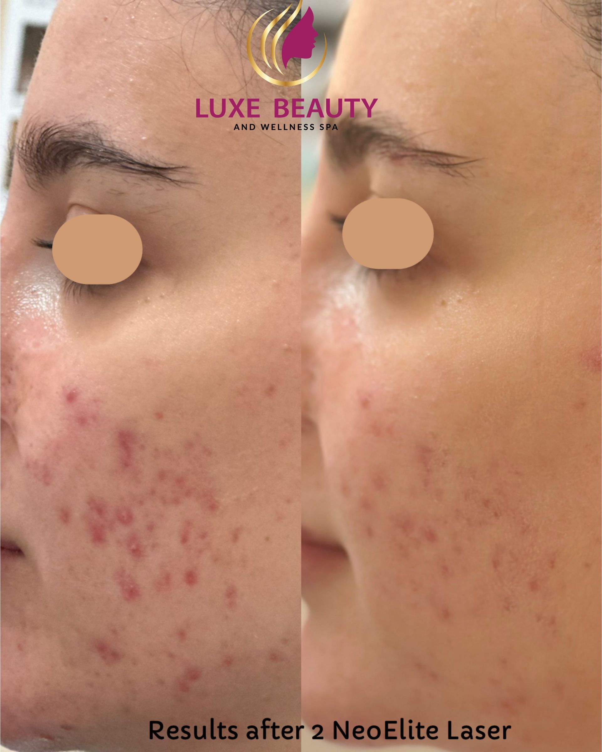 Before and after acne scar treatment with laser skin resurfacing in Mississauga