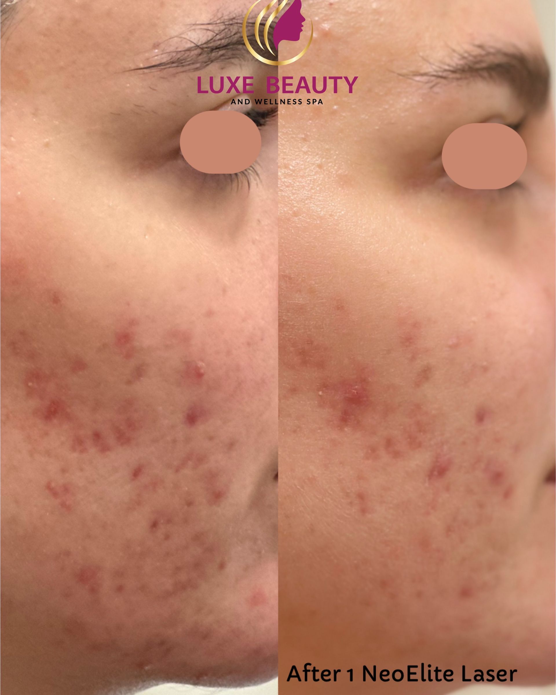 Before and after under eye and facial scar revision treatment in Mississauga