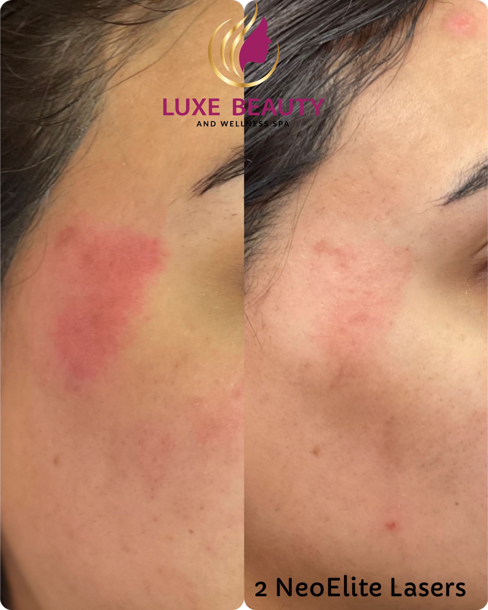 Before and after acne scar and redness reduction with laser treatment in Mississauga