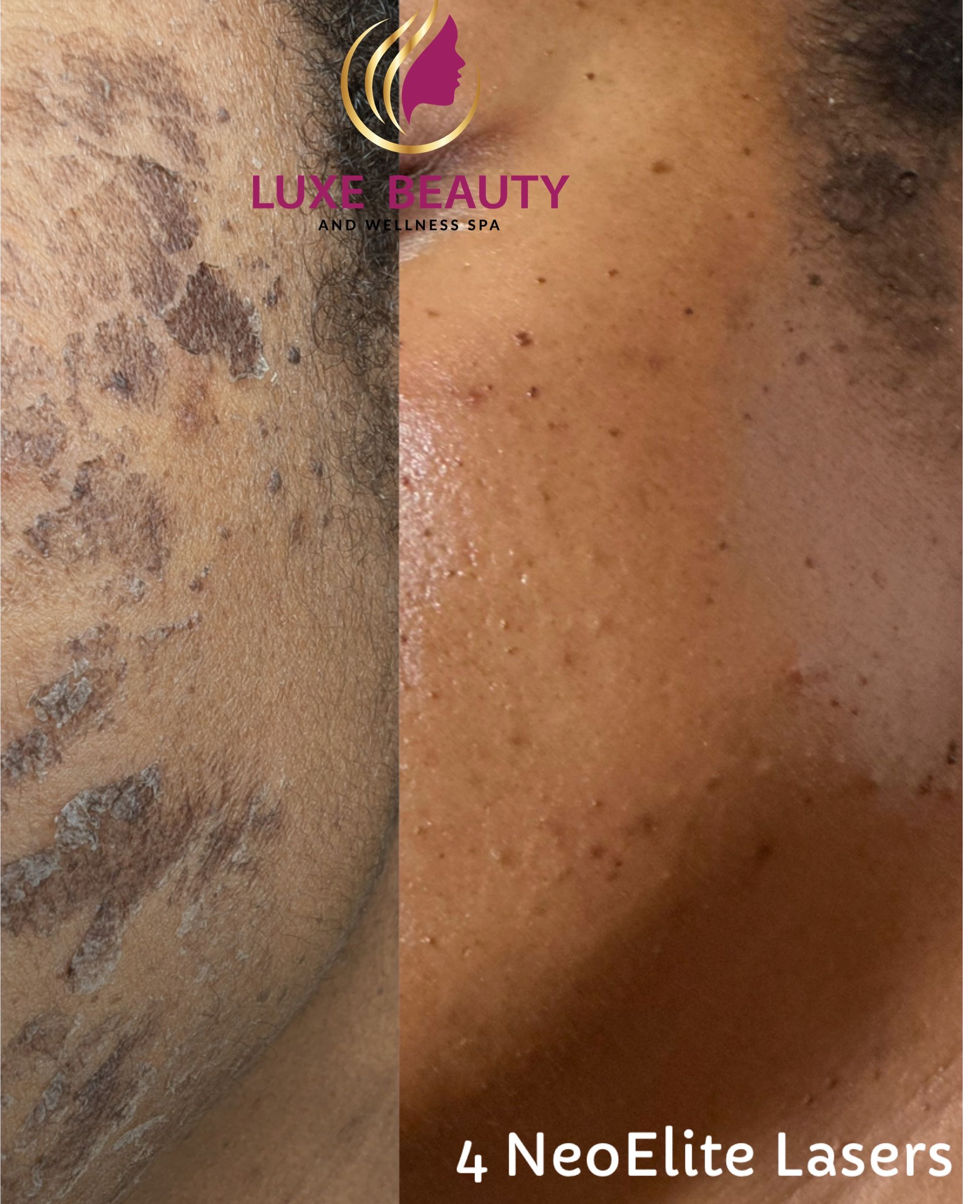 Before and after acne scar and skin texture improvement with laser treatment in Mississauga