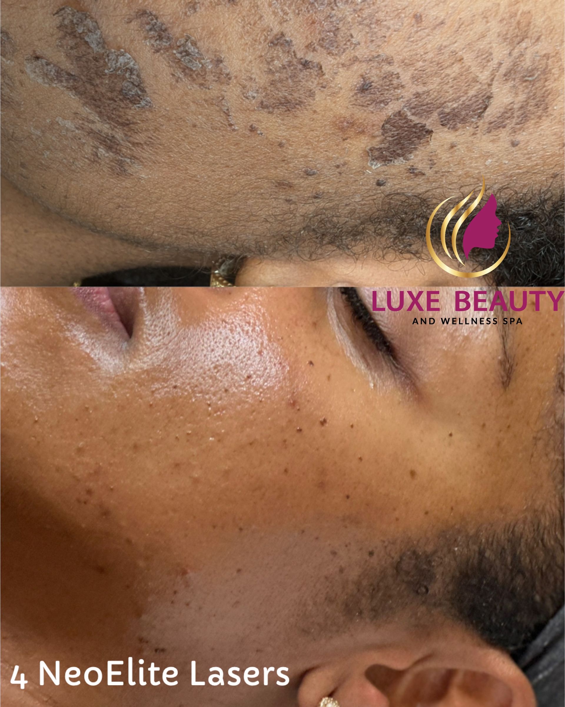 Before and after hyperpigmentation and dark spot treatment with Aerolase laser in Mississauga