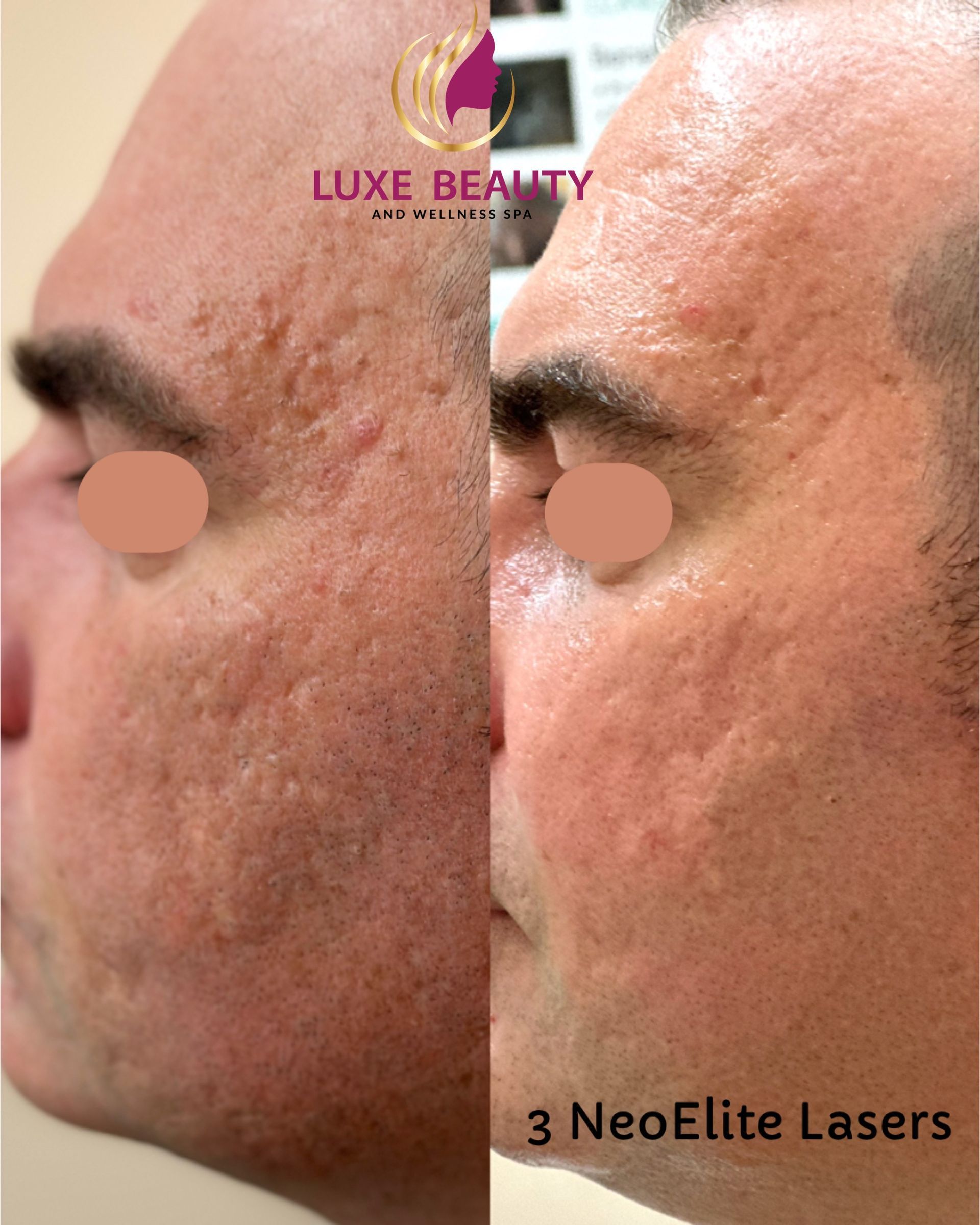 Before and after acne scar and skin texture improvement with laser treatment in Mississauga