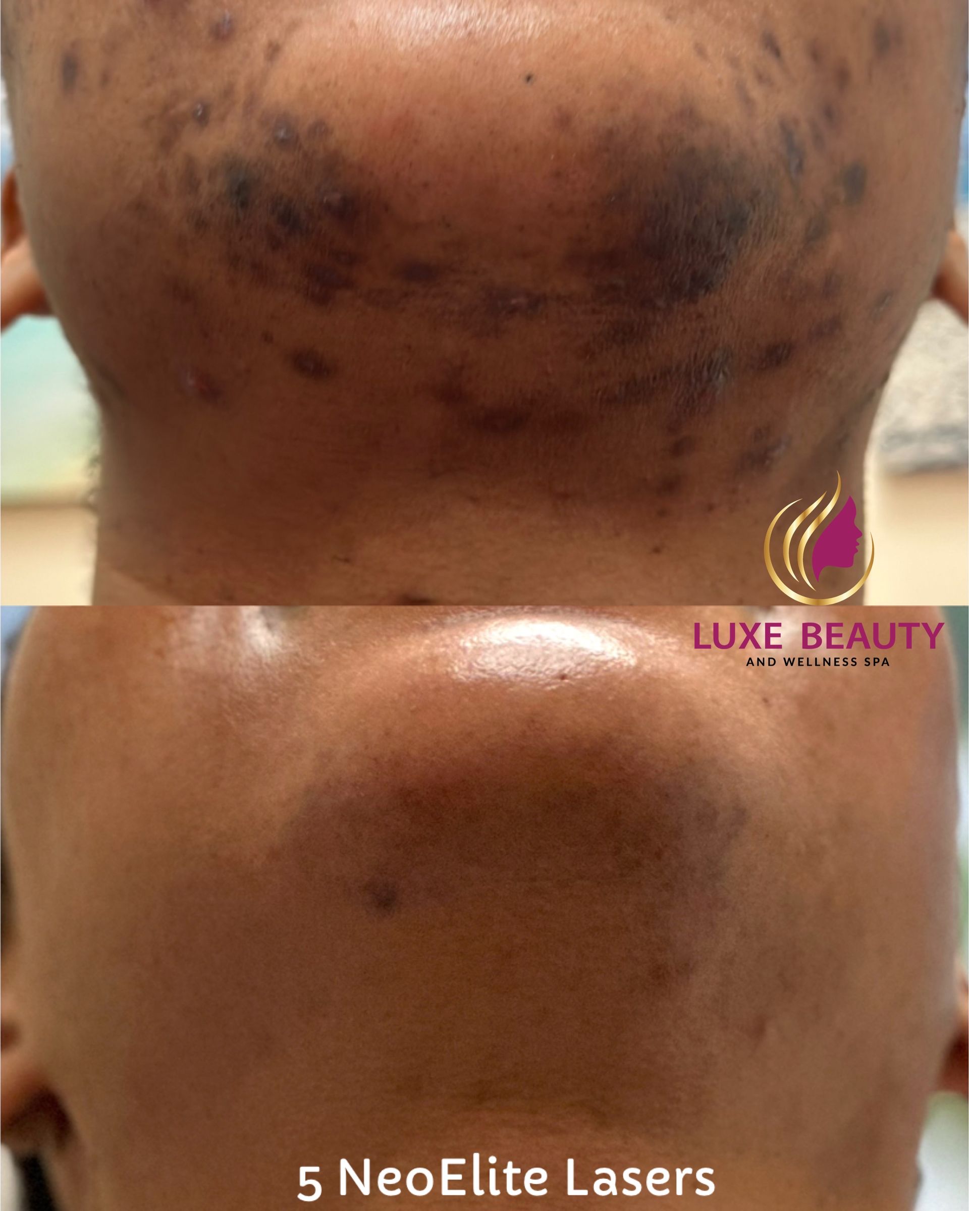 Before and after severe acne scarring and hyperpigmentation treatment in Mississauga
