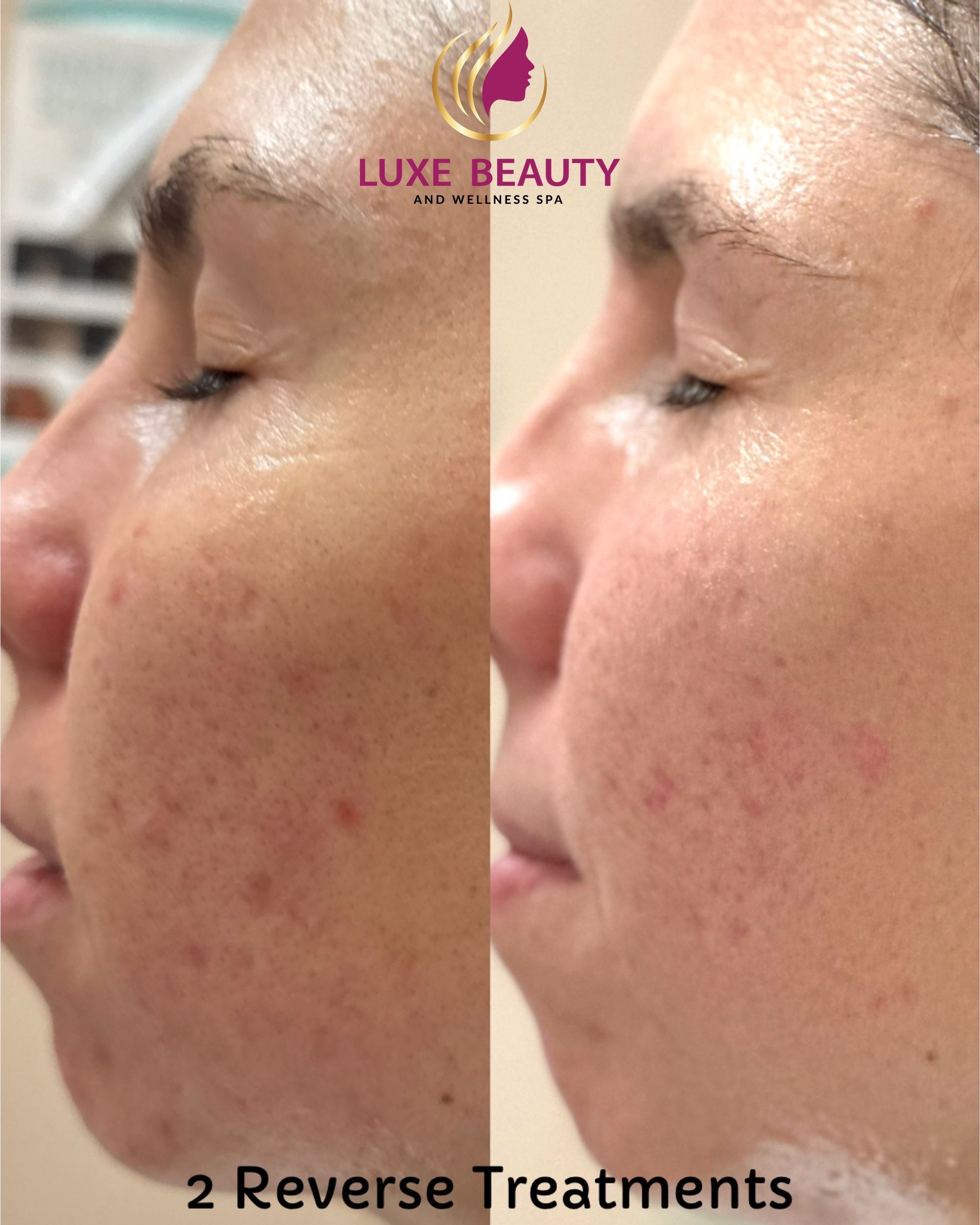 Before and after skin tone improvement and pigmentation correction with laser treatment in Mississauga