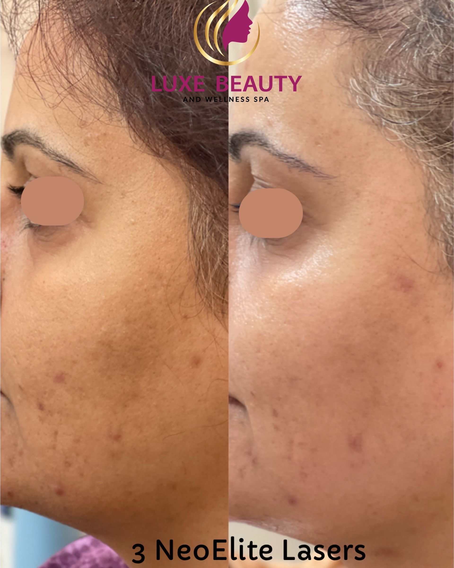 Before and after acne scar and uneven skin tone treatment in Mississauga