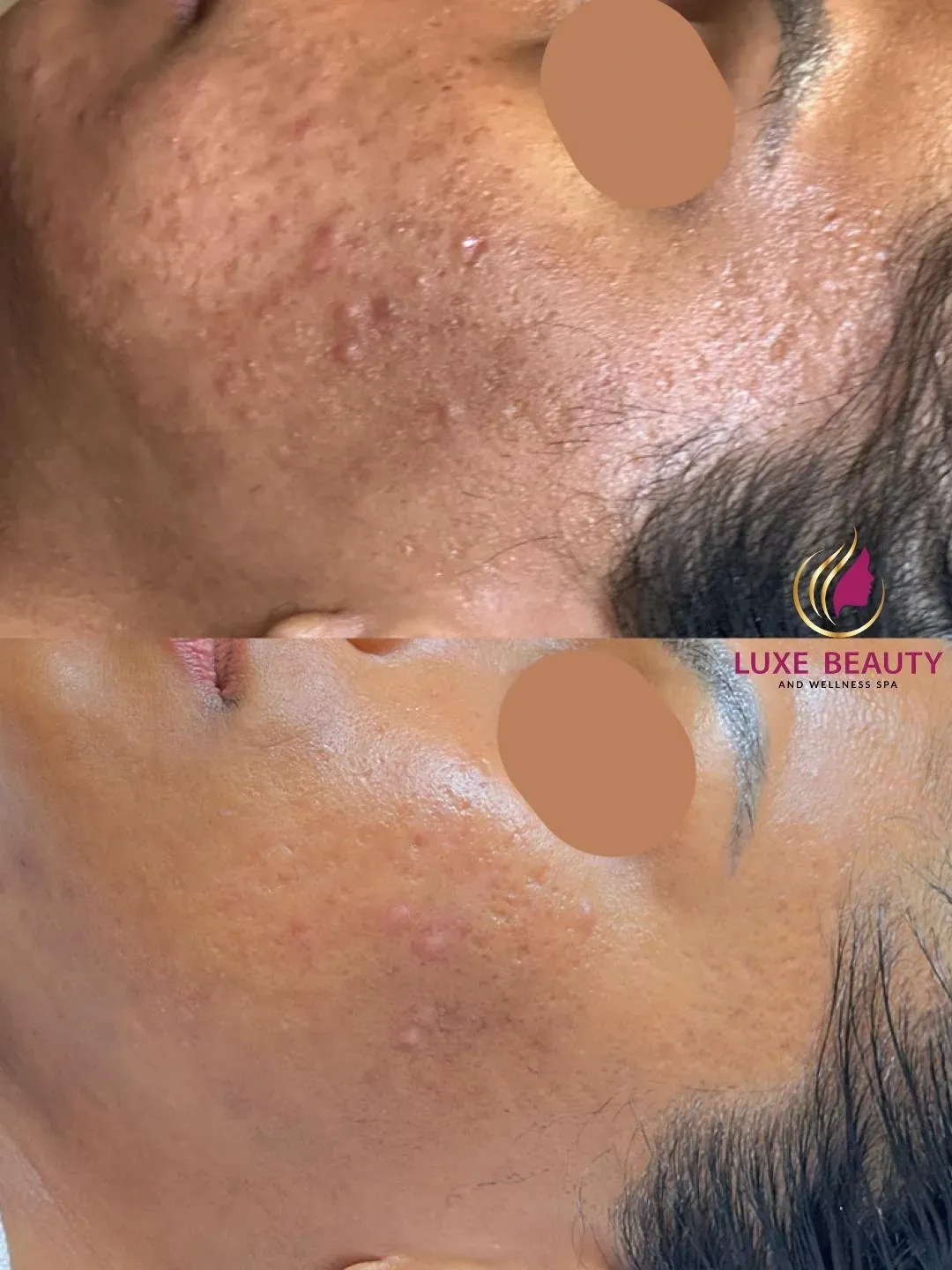 Aerolase laser treatment for fine lines and skin tightening on lower face in Mississauga