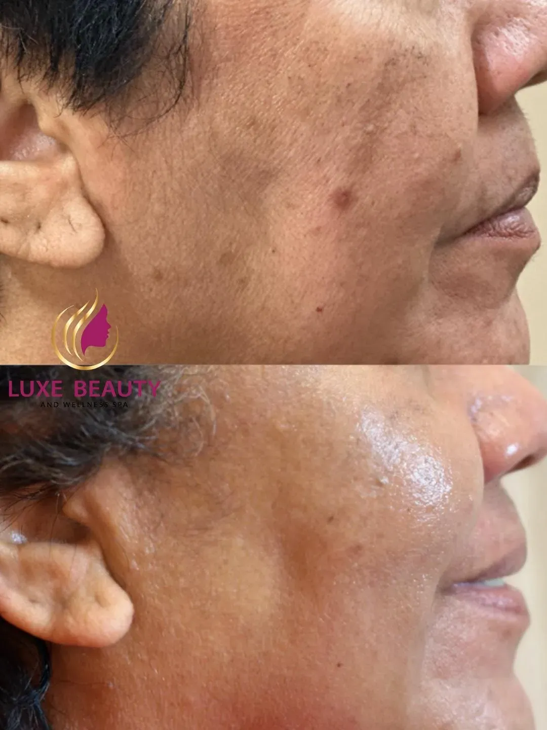 Laser skin rejuvenation for improving skin texture and early signs of aging on temple area in Mississauga