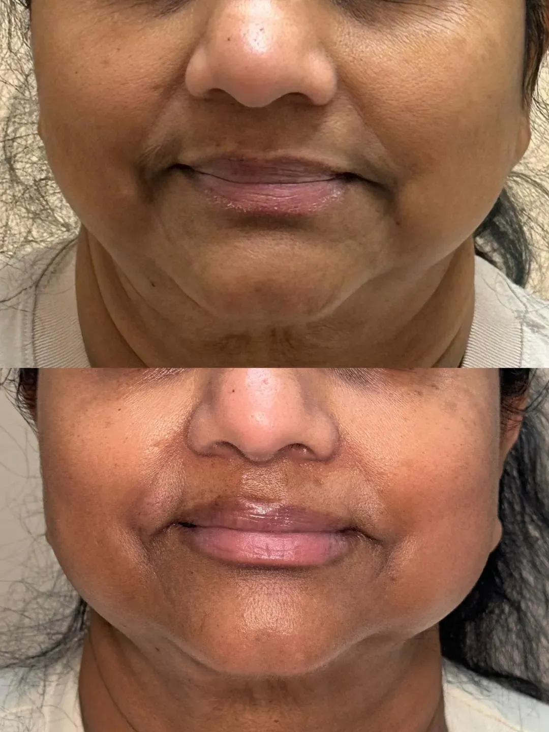 Aerolase laser treatment for acne and post-inflammatory hyperpigmentation on chin in Mississauga