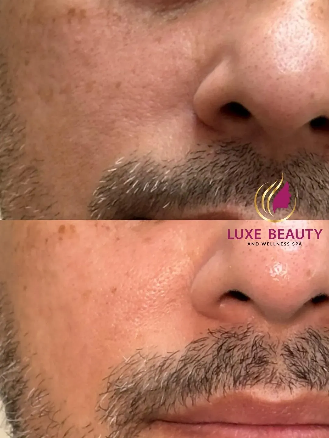 Aerolase laser treatment for improving skin tone and reducing redness on lower face in Mississauga