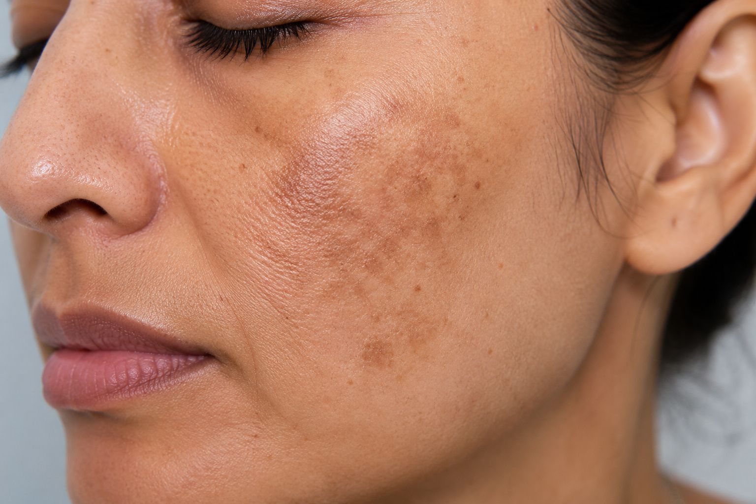 Close-up view of facial pigmentation and uneven skin tone before corrective skin treatment