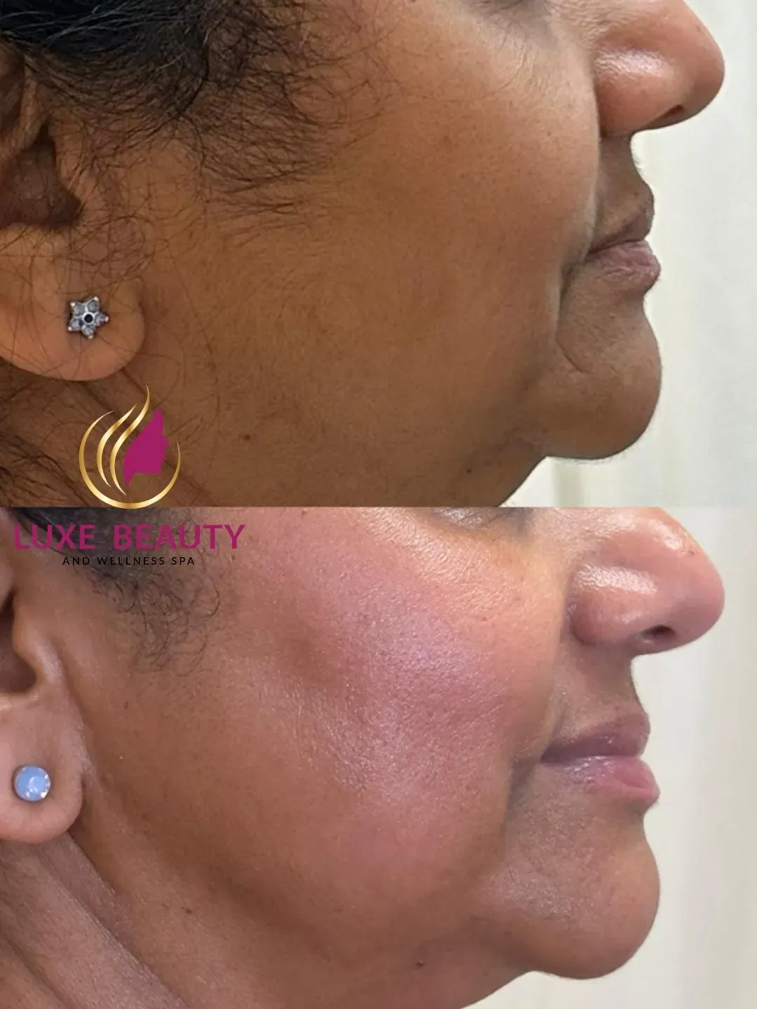Aerolase laser treatment for reducing redness and skin inflammation on face in Mississauga