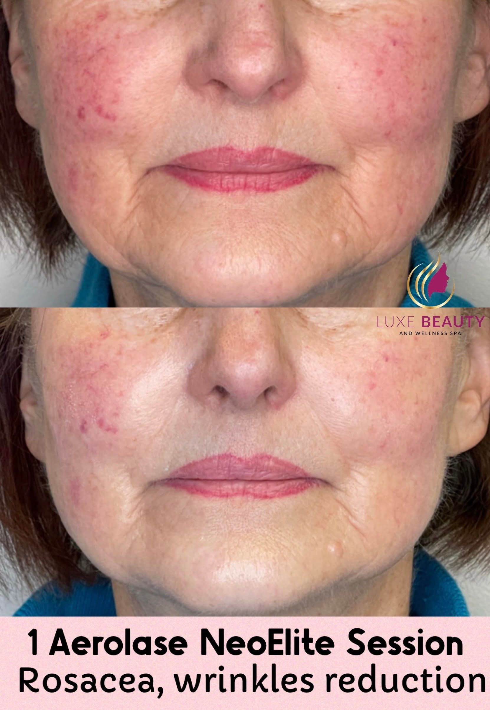 Aerolase laser treatment for fine lines and skin tightening on lower face in Mississauga