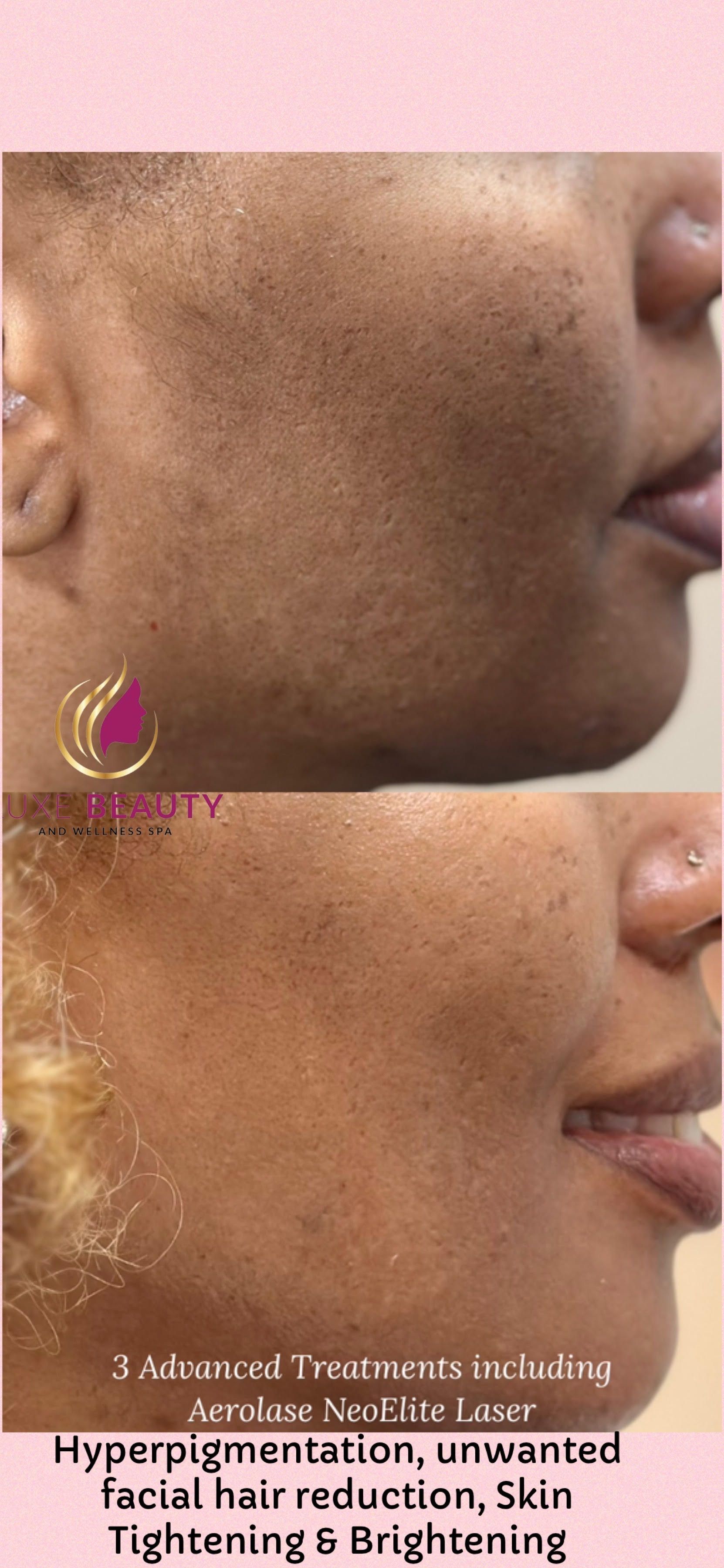 Laser treatment for enlarged pores and uneven skin texture on nose and cheek in Mississauga