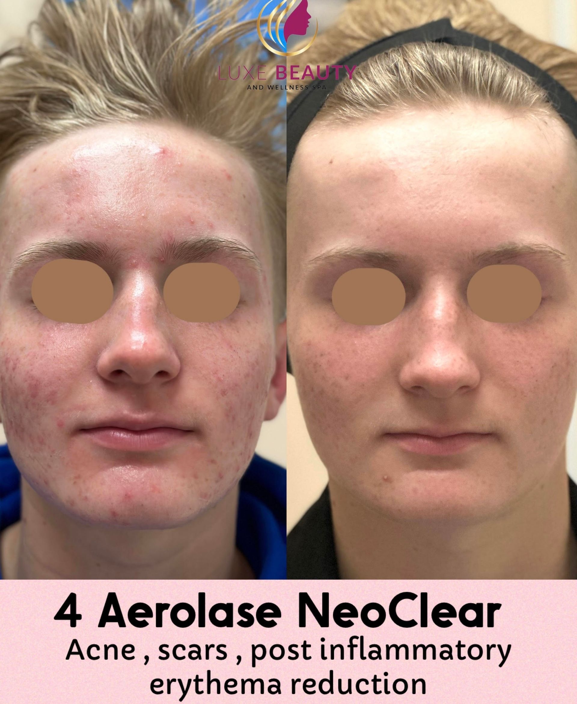 Before and after laser treatment for improving forehead texture and fine lines in Mississauga