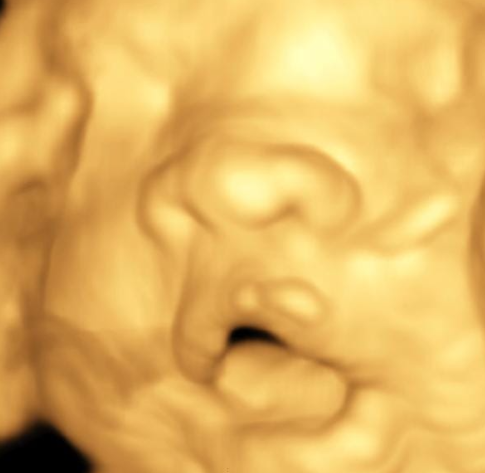 Imagen ecográfica en tono sepia de un feto, que muestra la cara y la parte superior del cuerpo.