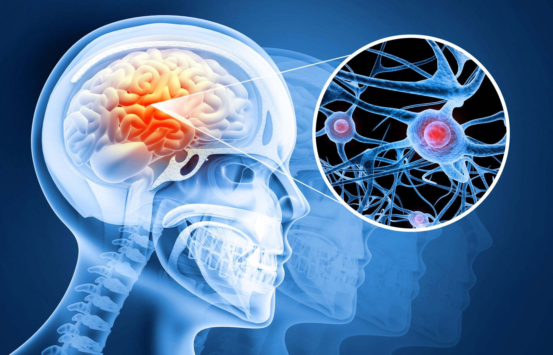 severity of TBI 