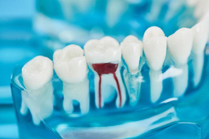 Modello dentale che mostra una dentatura con un dente danneggiato e arrossato a livello del bordo gengivale.