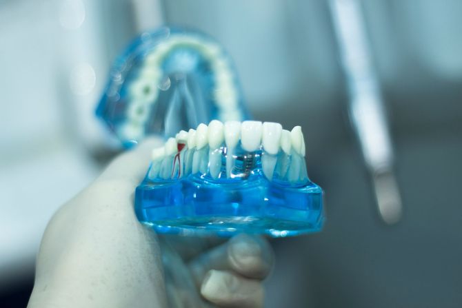 Un dentista tiene in mano delle impronte dentali blu con file di denti bianchi in un ambiente clinico.