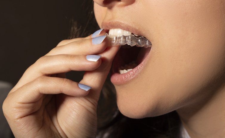 clear aligners