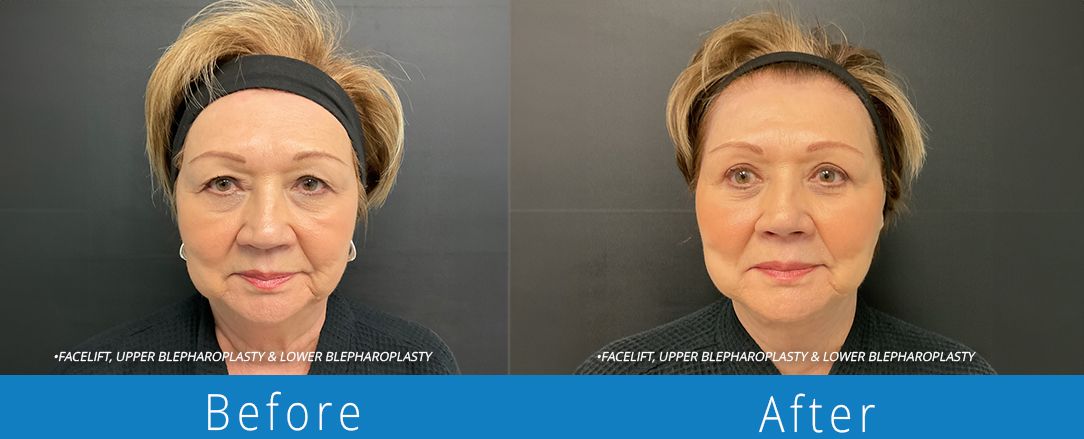 Eyelid surgery before & after  Beaches Facial Plastic & Nasal Surgery Center - the top surgeon for a blepharoplasty or eyelid surgery in Jacksonville or Northeast Florida.