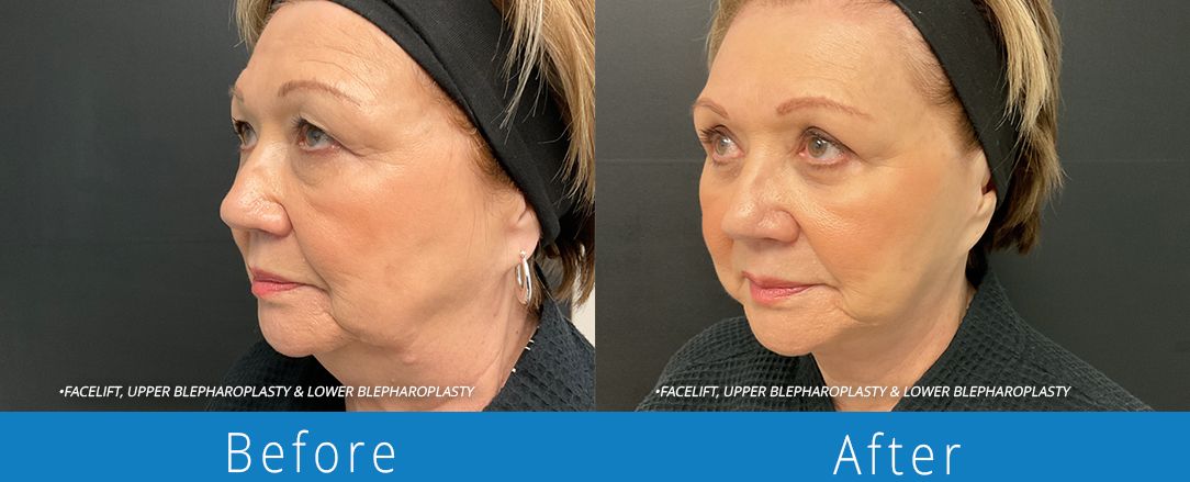 Eyelid surgery before & after  Beaches Facial Plastic & Nasal Surgery Center- the top surgeon for a blepharoplasty or eyelid surgery in Jacksonville or Northeast Florida.