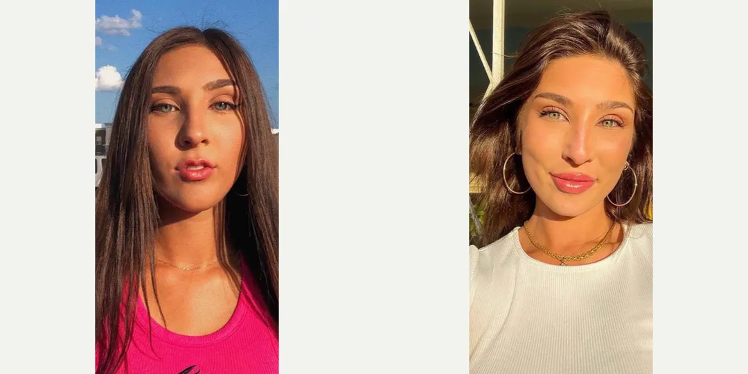 Juvaderm filler before & after from Beaches Facial Plastic Surgery - the top place for juvaderm dermal filler treatment in Jacksonville or Northeast Florida. 