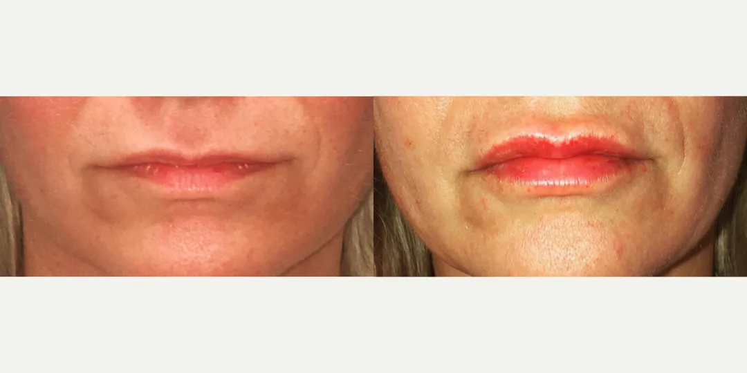Juvaderm filler before & after from Beaches Facial Plastic Surgery - the top place for juvaderm dermal filler treatment in Jacksonville or Northeast Florida. 