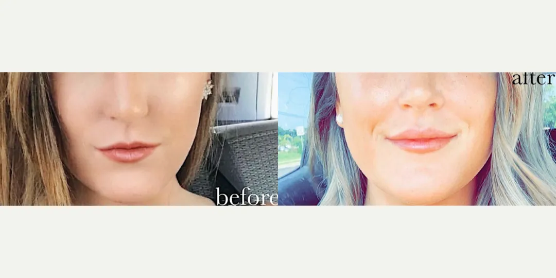 Juvaderm filler before & after from Beaches Facial Plastic Surgery - the top place for juvaderm dermal filler treatment in Jacksonville or Northeast Florida. 